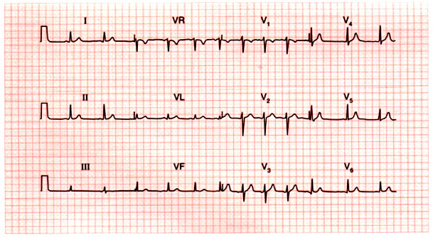 شرح تخطيط القلب الكهربائي ECG وتحديد الحالة من رسم القلب 14_10