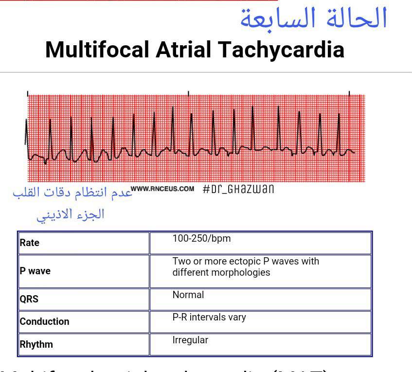 شرح تخطيط القلب الكهربائي ECG وتحديد الحالة من رسم القلب 15085625_1217594668327682_8137629222682782115_n-1