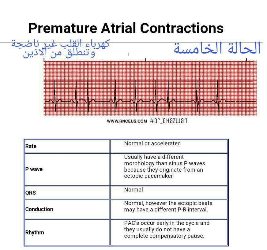 شرح تخطيط القلب الكهربائي ECG وتحديد الحالة من رسم القلب 15107443_1217594601661022_5984485869164233173_n-1