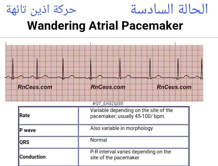 شرح تخطيط القلب الكهربائي ECG وتحديد الحالة من رسم القلب 15171137_1217594641661018_5292011426447438579_n-1