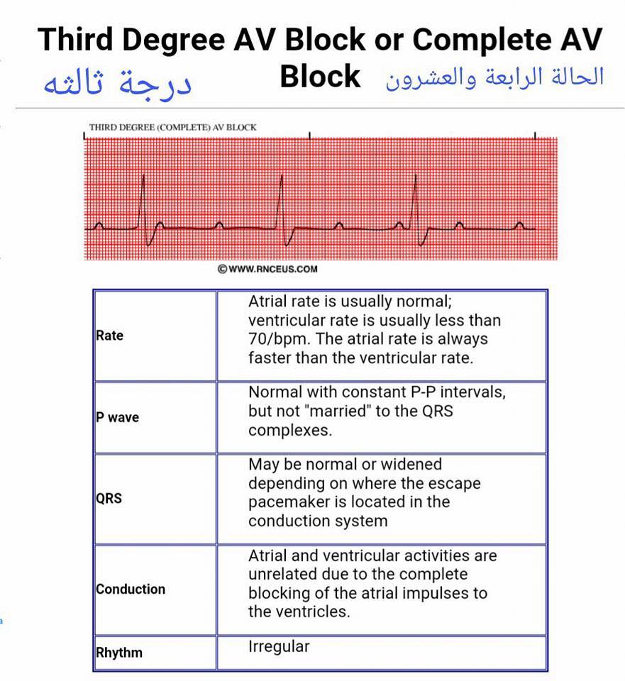 شرح تخطيط القلب الكهربائي ECG وتحديد الحالة من رسم القلب 15178244_1217595168327632_5870838082666498339_n