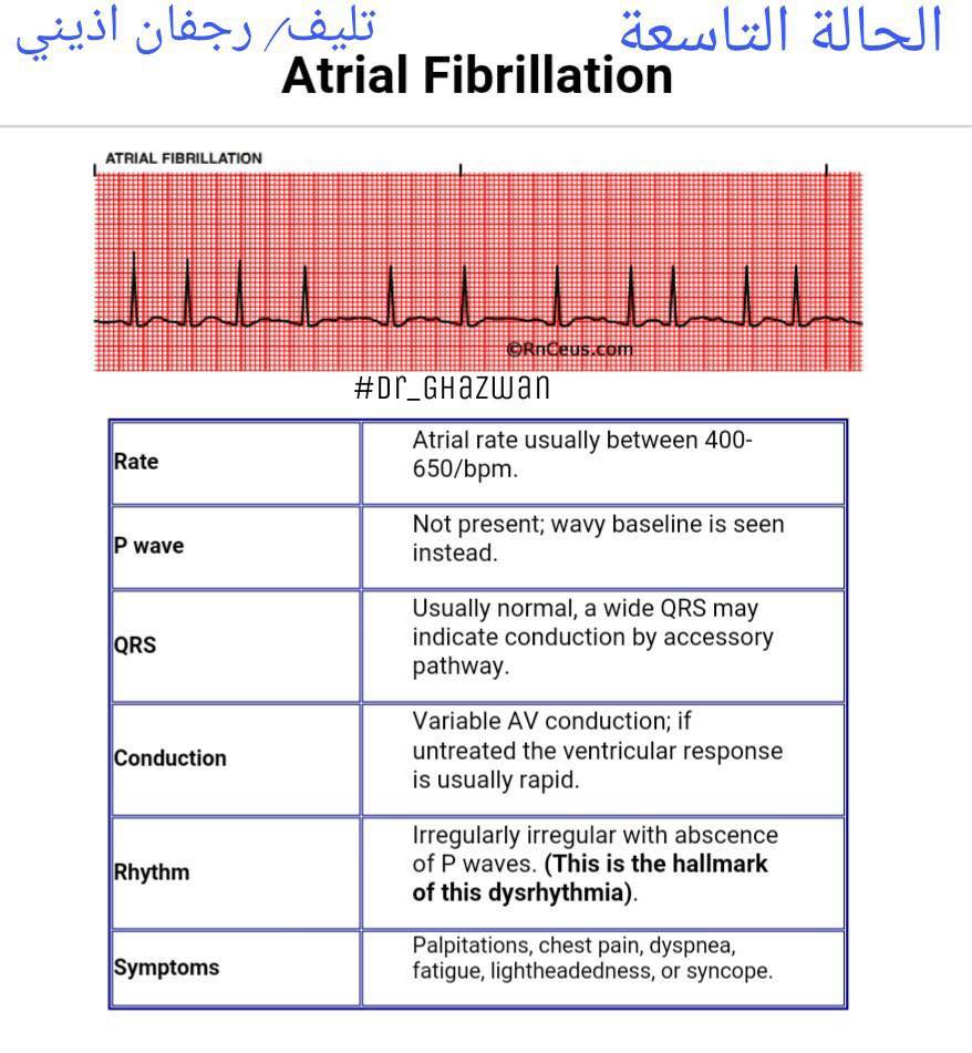 شرح تخطيط القلب الكهربائي ECG وتحديد الحالة من رسم القلب 15178286_1217594711661011_6093817026478602976_n-1