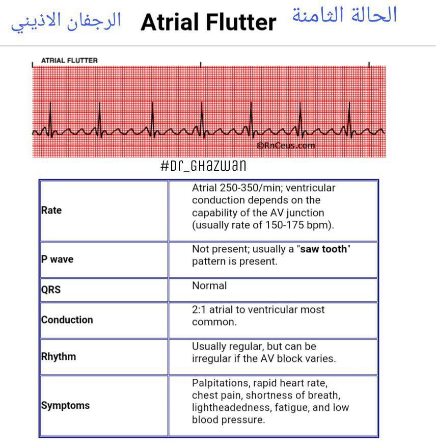 شرح تخطيط القلب الكهربائي ECG وتحديد الحالة من رسم القلب 15181147_1217594694994346_8255193496564683662_n-1