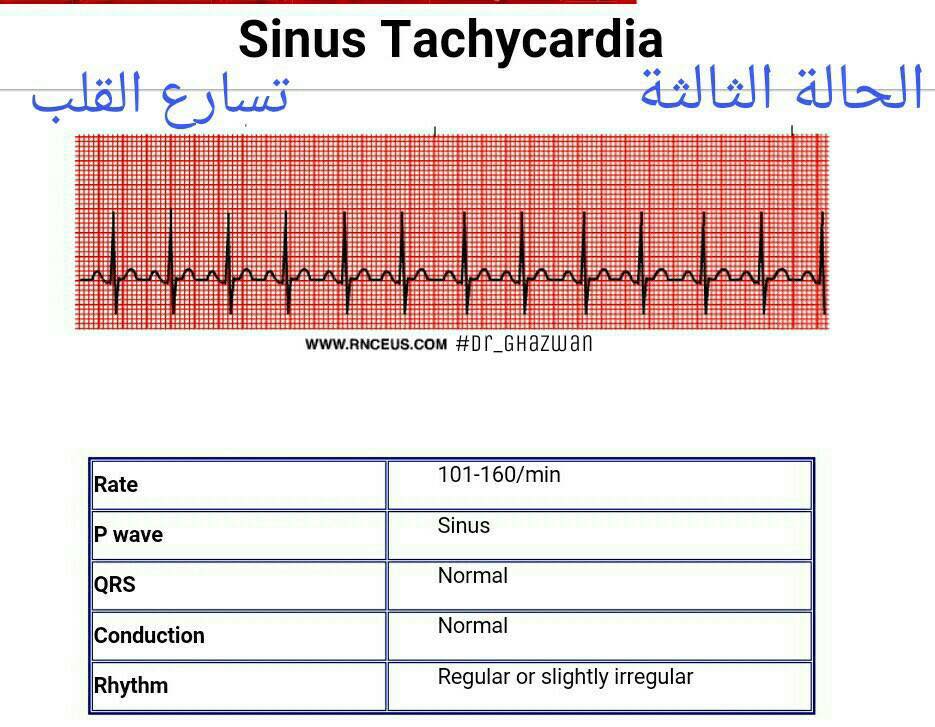 شرح تخطيط القلب الكهربائي ECG وتحديد الحالة من رسم القلب 15181577_1217594568327692_1720056685799137282_n