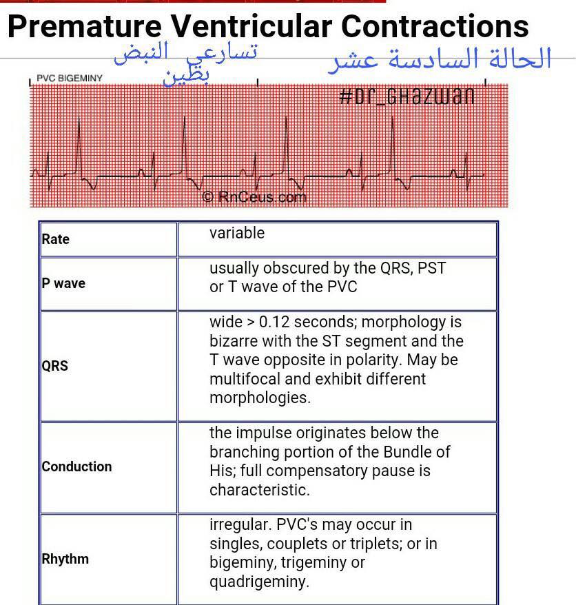 شرح تخطيط القلب الكهربائي ECG وتحديد الحالة من رسم القلب 15192709_1217594968327652_6001065270712599461_n-1