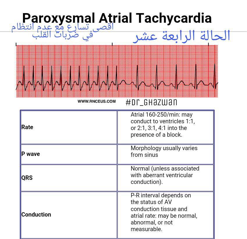 شرح تخطيط القلب الكهربائي ECG وتحديد الحالة من رسم القلب 15219500_1217594854994330_6607442371820876935_n-1
