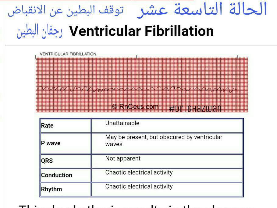 شرح تخطيط القلب الكهربائي ECG وتحديد الحالة من رسم القلب 15219582_1217595061660976_6338447804889988934_n-1