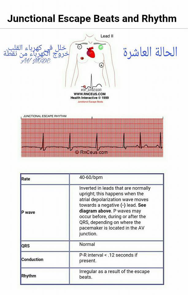 شرح تخطيط القلب الكهربائي ECG وتحديد الحالة من رسم القلب 15220032_1217594734994342_4765254012354290364_n-1