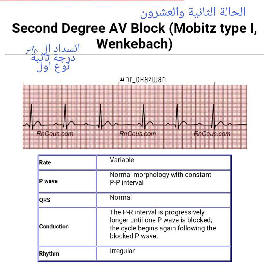 شرح تخطيط القلب الكهربائي ECG وتحديد الحالة من رسم القلب 15220066_1217595118327637_3576169908342771665_n