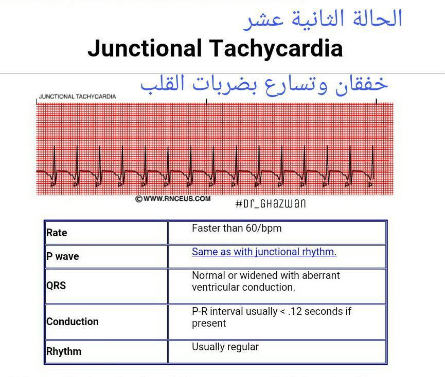 شرح تخطيط القلب الكهربائي ECG وتحديد الحالة من رسم القلب 15230591_1217594808327668_6309322440559731017_n-1