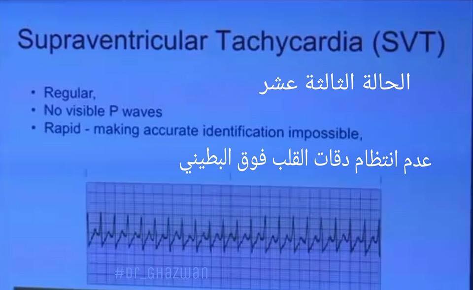شرح تخطيط القلب الكهربائي ECG وتحديد الحالة من رسم القلب 15232086_1217594828327666_6810224026488524227_n