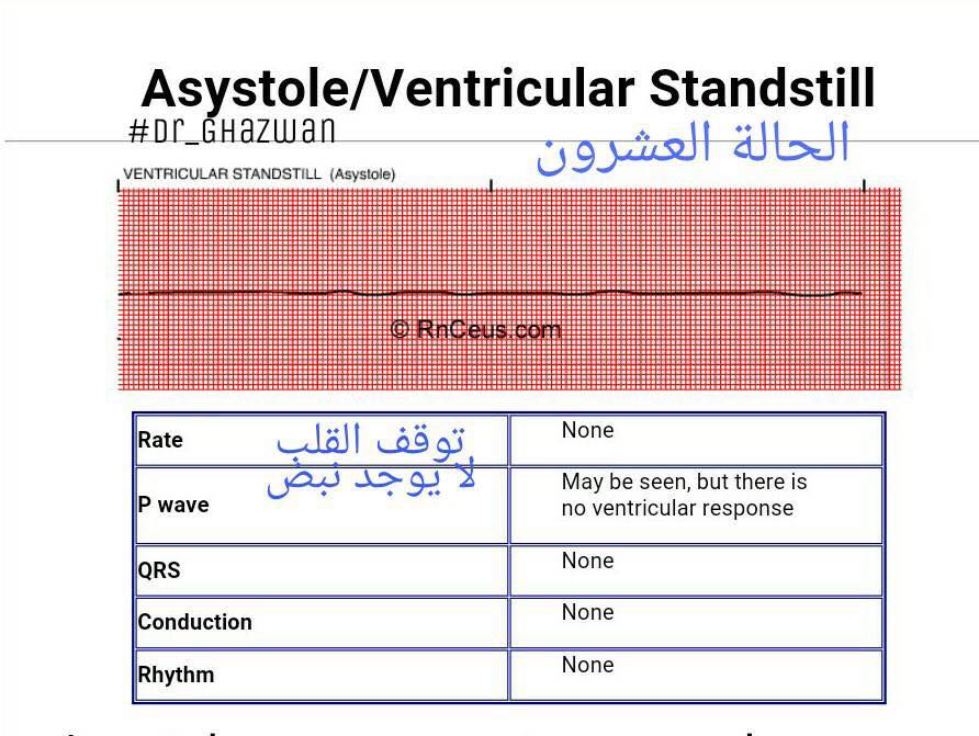 شرح تخطيط القلب الكهربائي ECG وتحديد الحالة من رسم القلب 15241862_1217595081660974_7988299944213701120_n-1