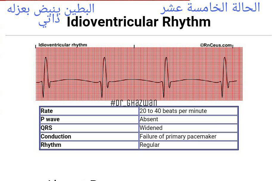 شرح تخطيط القلب الكهربائي ECG وتحديد الحالة من رسم القلب 15253503_1217594951660987_2045091690746961066_n-1