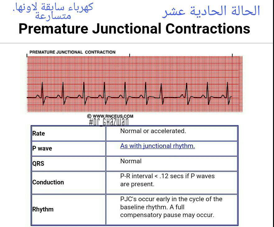 شرح تخطيط القلب الكهربائي ECG وتحديد الحالة من رسم القلب 15267576_1217594748327674_5451504831464810653_n-1